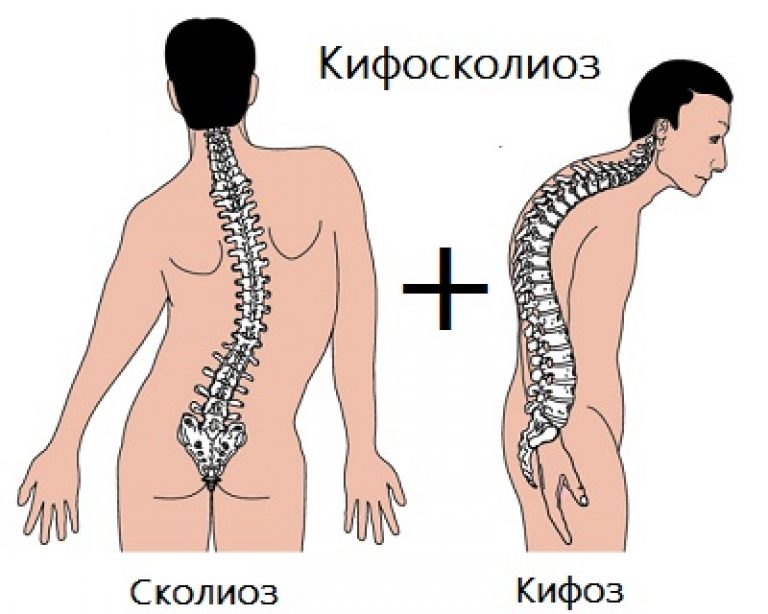 kifoskolioz